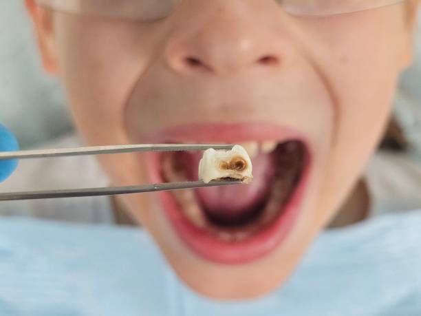 Best Emergency Tooth Extraction in Fairlawn, OH